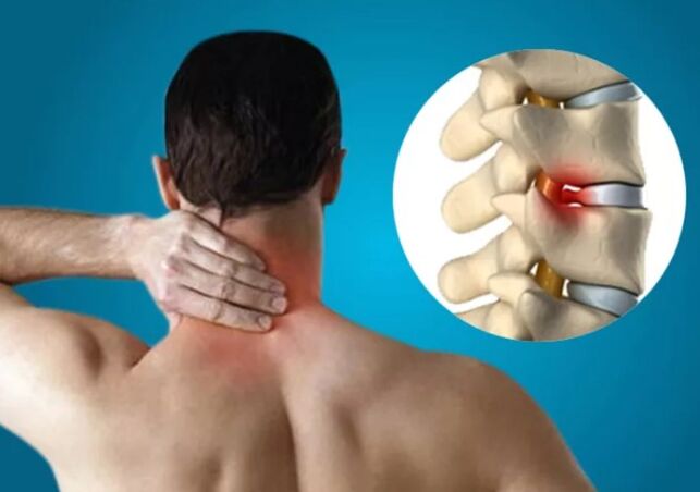 Zervikale Osteochondrose
