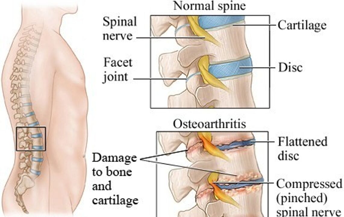 Der Unterschied zwischen einer gesunden Scheibe und einer Scheibe mit Osteochondose