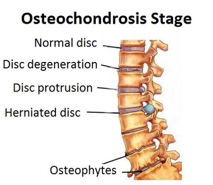 Osteochondrose -Phase