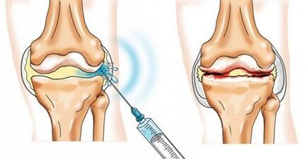 Wie man die Arthrose des Kniegelenks behandelt